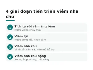 4 giai đoạn tiến triển viêm nha chu