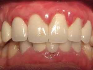 Danh sách thực phẩm cấm sau cạo vôi