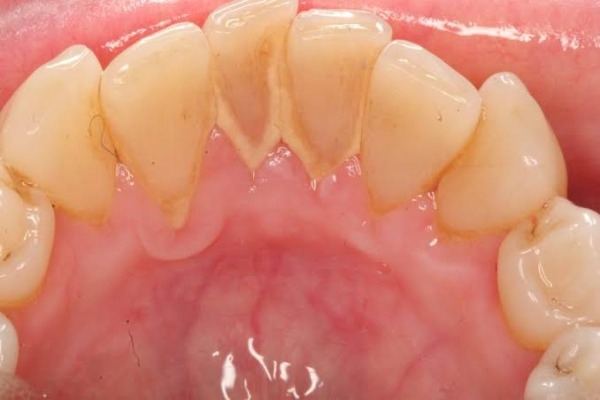 Cạo vôi răng xong bị chảy máu nhiều cần đến bác sĩ