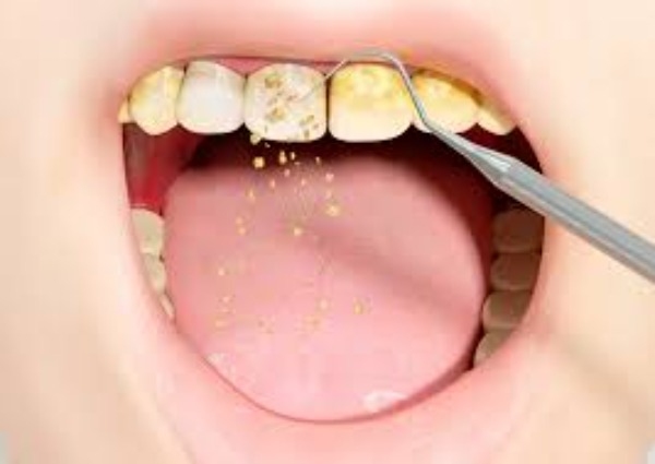 Cách máy siêu âm phá vỡ vôi răng