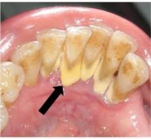 Lợi ích của lấy cao răng định kỳ