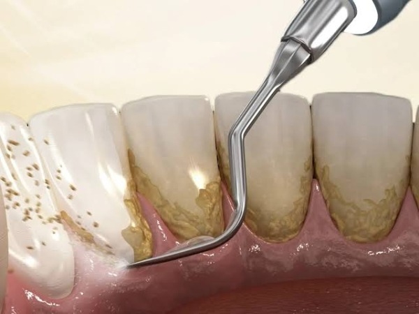 Tác hại khi cạo vôi quá thường xuyên