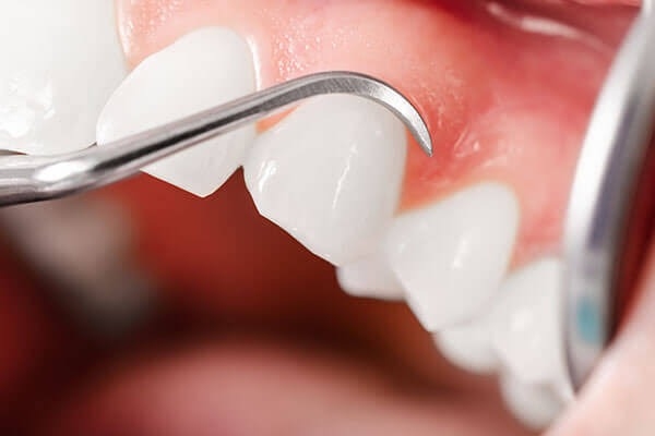 Cạo vôi răng nhiều có sao không