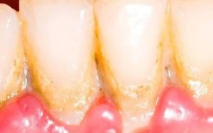 Cạo vôi răng có được uống bia không