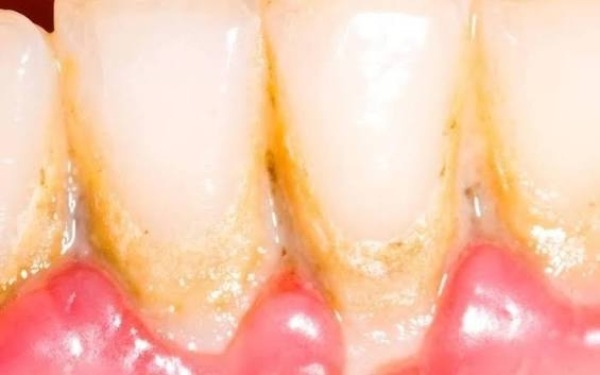 Cạo vôi răng có được uống bia không