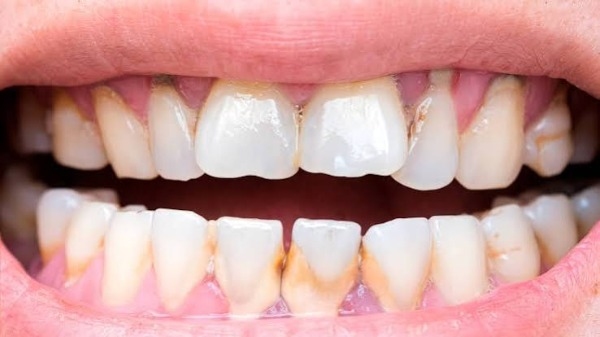 Cạo vôi không làm răng yếu