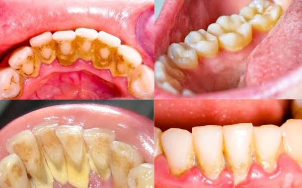 Cao răng lấy xong thì khi nào ăn được