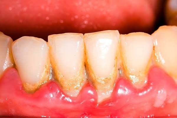 Vôi răng bám nhiều do thực phẩm