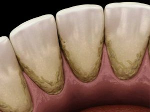 Lấy cao răng định kỳ mỗi 3-6 tháng
