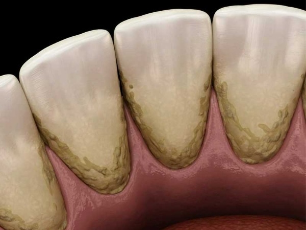 Lấy cao răng định kỳ mỗi 3-6 tháng