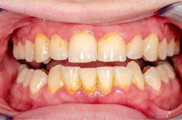 Cạo vôi răng không gây ảnh hưởng gì đến sức khỏe