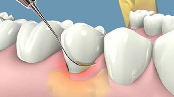 Cạo vôi răng thường xuyên