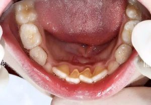 Viêm nướu do uống bia sau cạo vôi sẽ xuất hiện trong vài giờ đến vài ngày