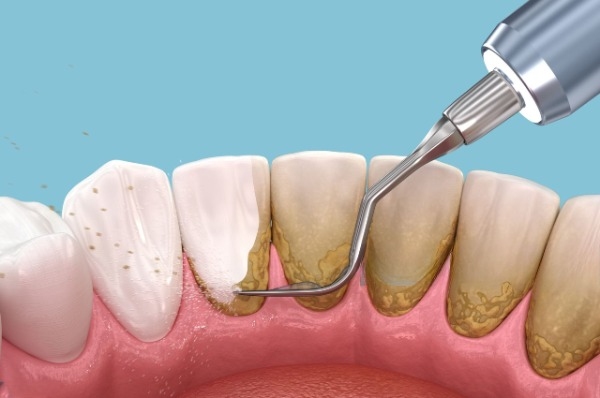 Cạo vôi răng sau vài giờ là hết ê buốt