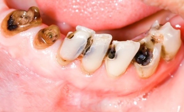 Tủy bị viêm