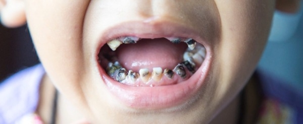 sâu răng sữa ở trẻ