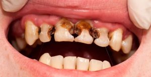 Ảnh hưởng đến răng vĩnh viễn