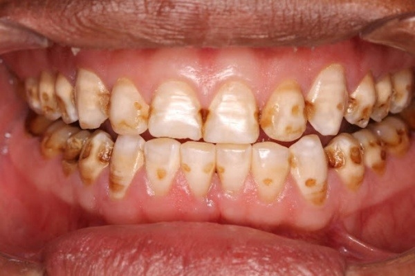 Gãy dọc thân răng là điểm không cứu