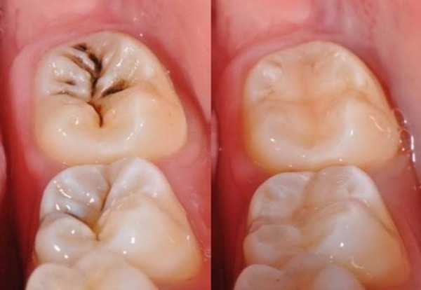 Trám răng xong bị ê buốt
