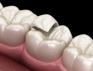 Cách giảm ê buốt tại nhà hiệu quả