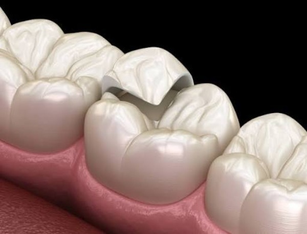 Cách giảm ê buốt tại nhà hiệu quả
