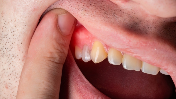 Viêm nướu chảy máu