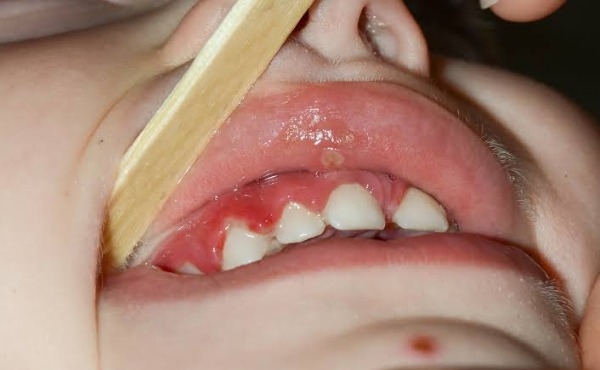 Viêm nướu