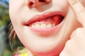 Nướu xung quanh một chiếc răng sưng đỏ