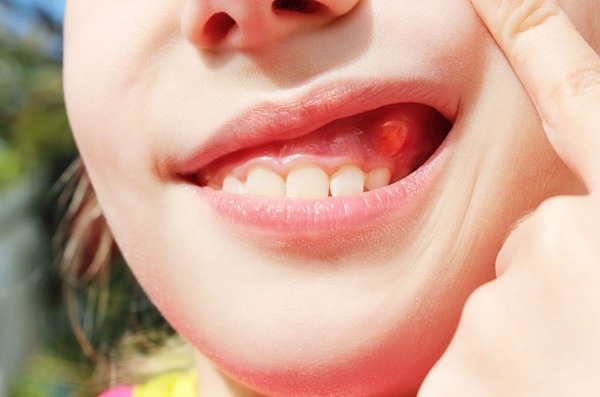 Nướu xung quanh một chiếc răng sưng đỏ