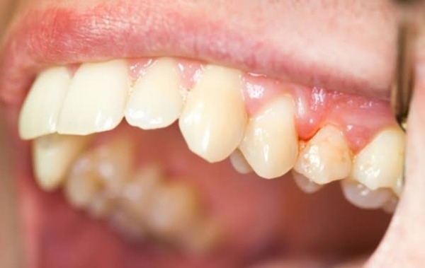 Vì sao nướu sưng quanh một răng
