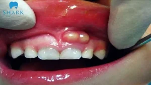 Nướu nổi cục trắng cạnh chân răng