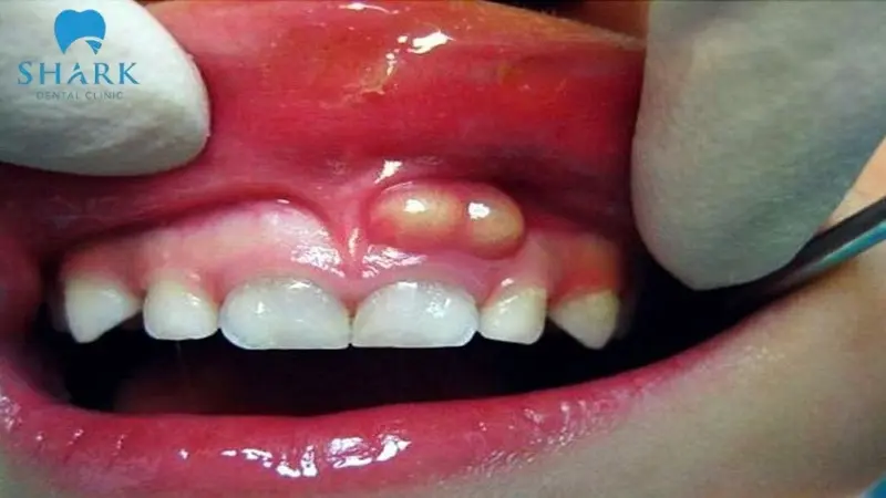 Nướu nổi cục trắng cạnh chân răng