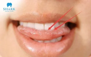 Lưỡi nứt rãnh