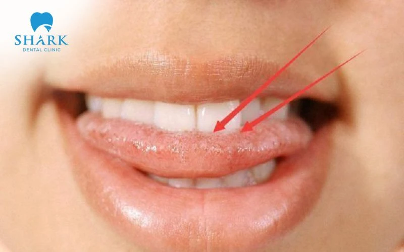 Lưỡi nứt rãnh
