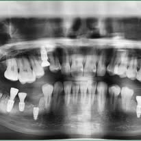 Chụp X-quang để đánh giá chính xác tình trạng trước khi điều trị