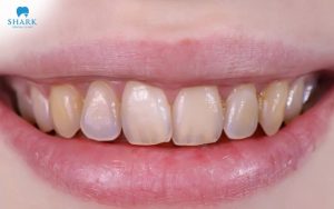 Khe tam giác gây tích tụ thức ăn và vi khuẩn