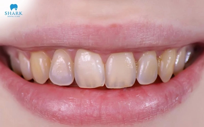 Khe tam giác gây tích tụ thức ăn và vi khuẩn