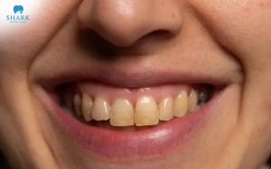 Răng đổi màu xám sau chấn thương